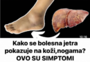 Kako se bolesna jetra manifestira na koži i nogama? OVO SU ZNAKOVI BOLESNE JETRE… (SLIKA)