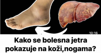 Kako se bolesna jetra manifestira na koži i nogama? OVO SU ZNAKOVI BOLESNE JETRE… (SLIKA)