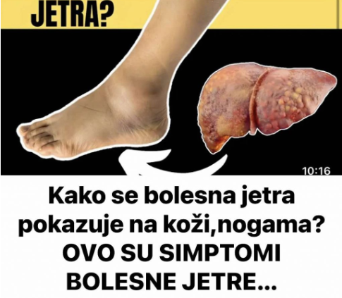 Kako se bolesna jetra manifestira na koži i nogama? OVO SU ZNAKOVI BOLESNE JETRE… (SLIKA)