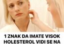 1 ZNAK DA IMATE VISOK HOLESTEROL VIDI SE NA OČIMA: Ovaj simptom je OČIGLEDAN