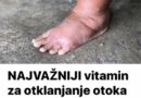 NAJVAŽNIJI vitamin za otklanjanje otoka ruku, nogu i stopala!