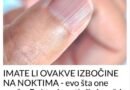 IMATE LI OVAKVE IZBOČINE NA NOKTIMA – Evo Šta One Znače: Doktorica Otkrila I Možda Ćete Se Iznenaditi